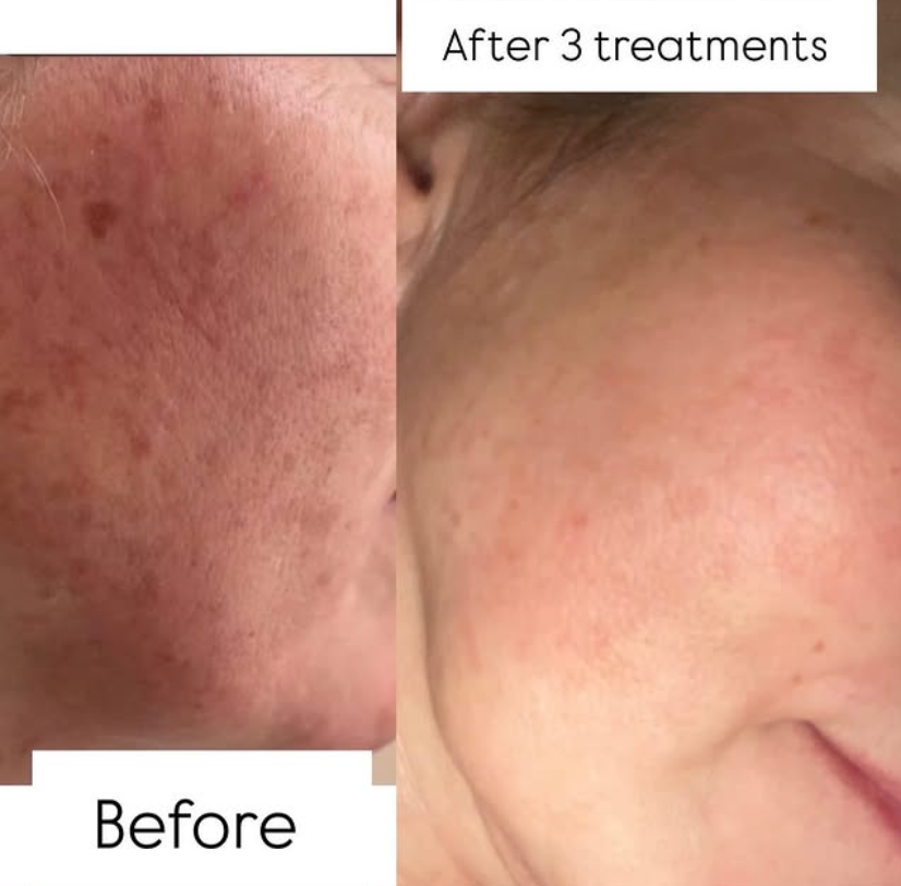 Fabulous dermaplaning result at Beauty by Bex
